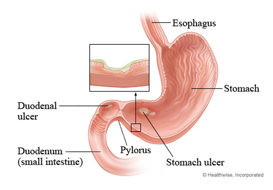 duodenal-ulcer