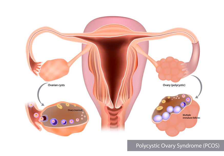 polycystic-ovaries